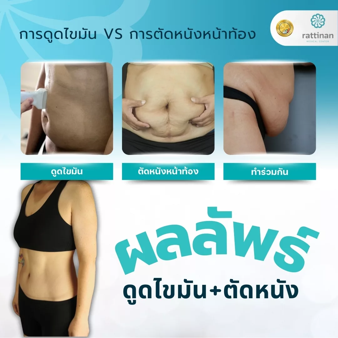 การดูดไขมัน VS การตัดหนังหน้าท้อง