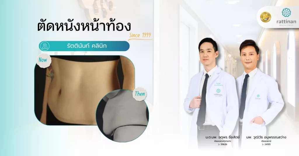 ตัดหนังหน้าท้อง Tummy Tuck