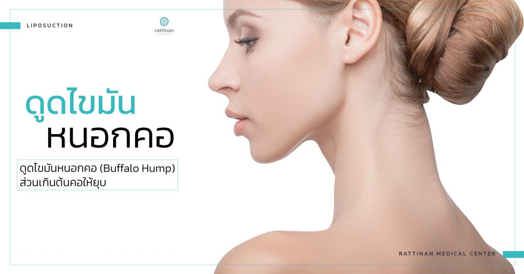 buffalo hump liposuction service