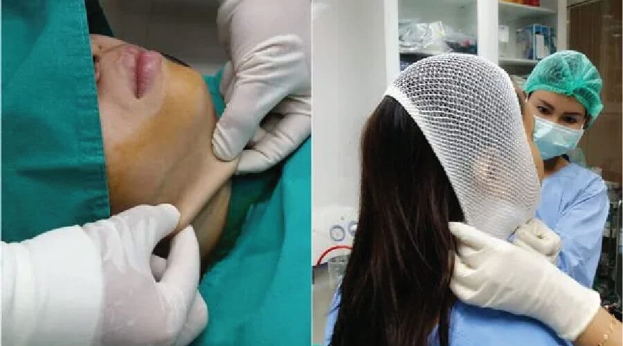 liposuction chin